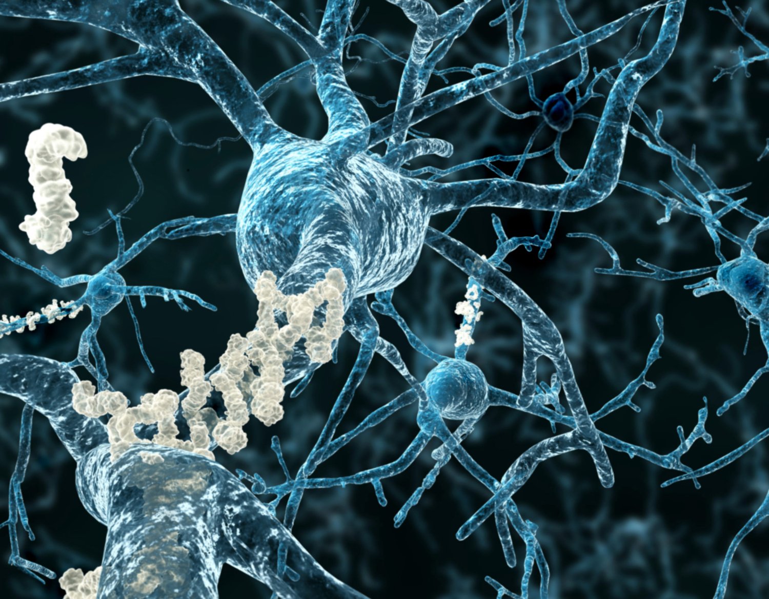 Amyloid plaques in the brain in Alzheimer's disease