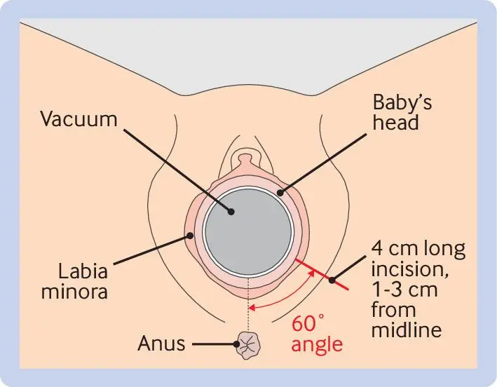 Illustration of a lateral episiotomy in the EVA trial