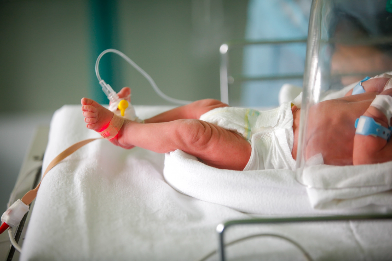 Hydrocortisone may reduce the risk of lung disease in extremely premature babies