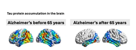 Tau accumulation in the brain