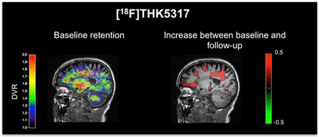 Tracking Tau Accumulation. Tau PET ligands allow researchers to see regions (red) where tau tangles build up in an individual as prodromal Alzheimer’s progresses. Photo courtesy of Agneta Nordberg.