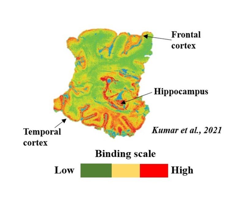 The binding of the PET-tracer BU99008 shows reactive astrogliosis in different parts of the brain of a deceased patient with Alzheimer's disease. The colours show the extent of the binding, where green is low, yellow is medium, and red is high binding.