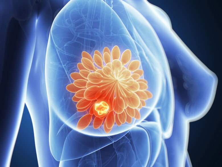 3D rendered illustration of breast cancer