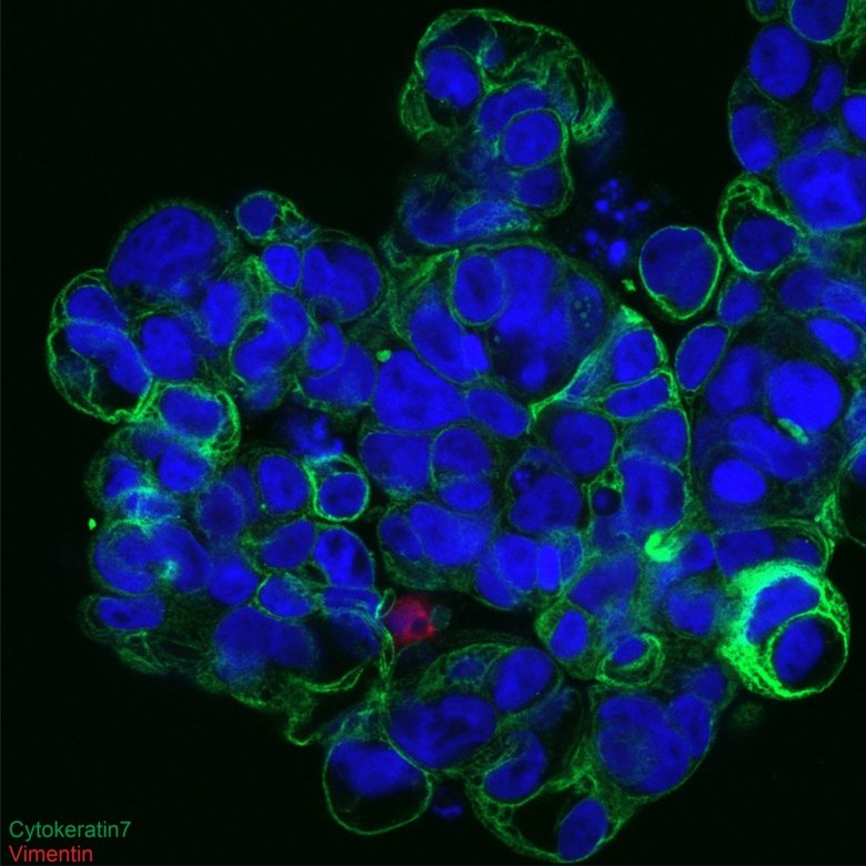 A cluster of cancer cells isolated from the ascites fluid of a patient with high grade serous ovarian cancer (Nucleus: blue, Cytokeratin 7: green, Vimentin: red)