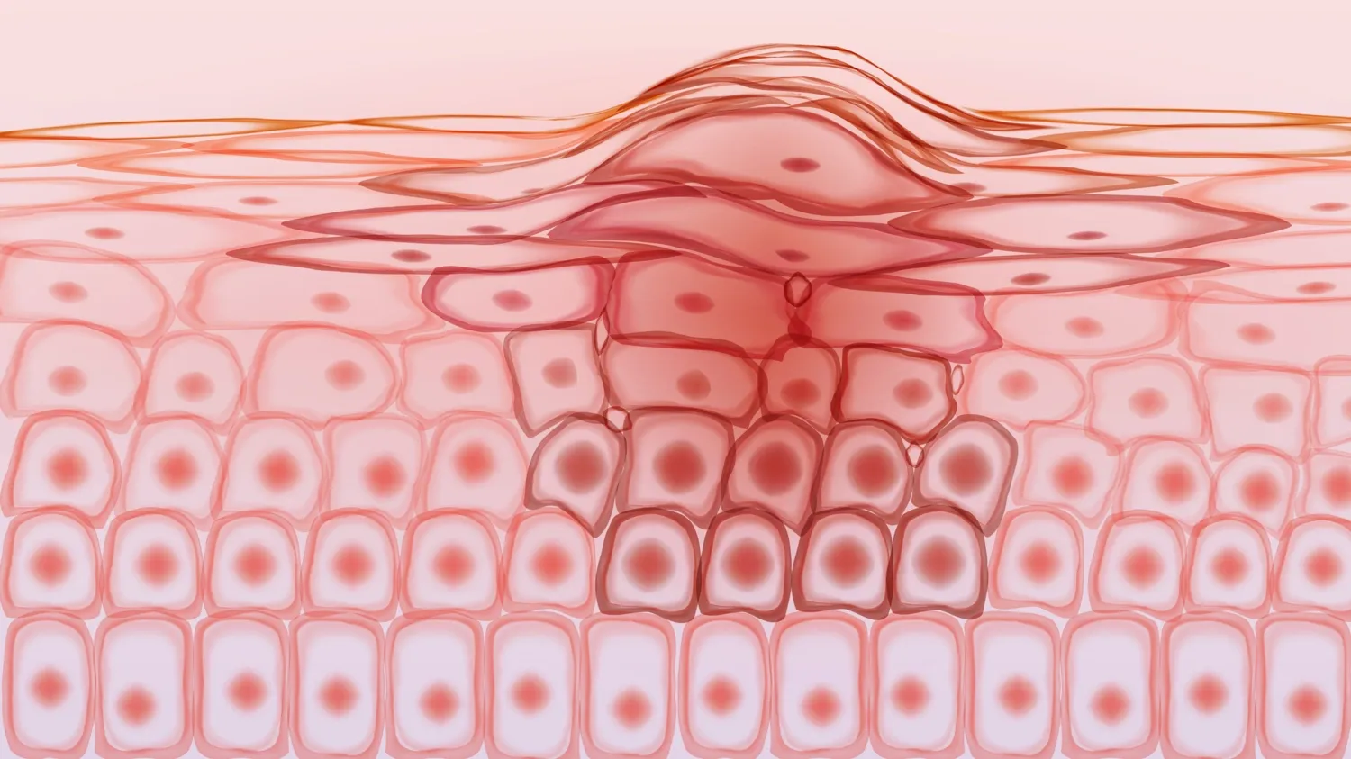 Illustration of skin cancer cells.
