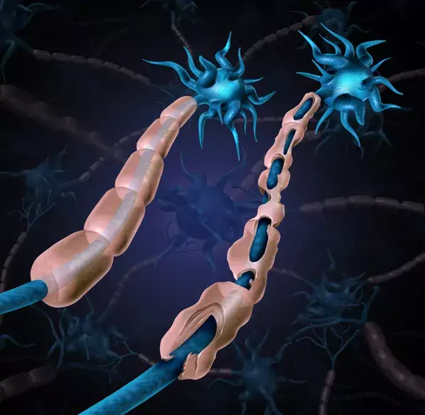 Illustration of healthy and damaged neurons, one of each.