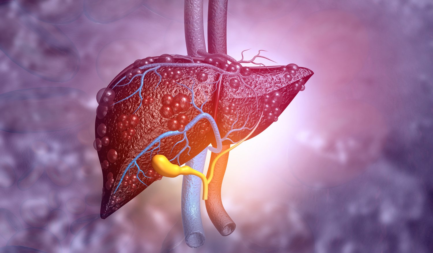 Illustration of a non-healthy liver.