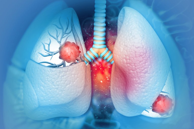 Illustration of lung cancer