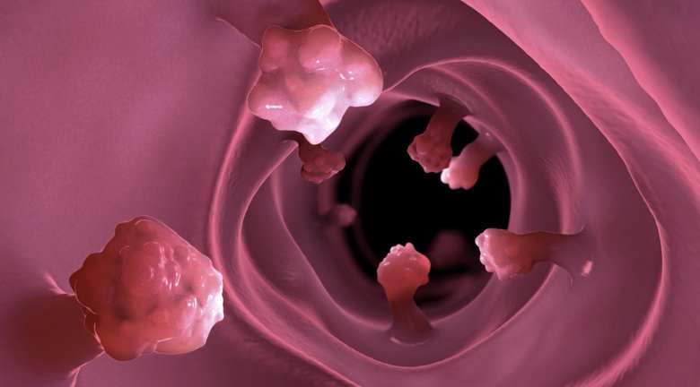 Illustration of intestinal polyps that can cause colorectal cancer.