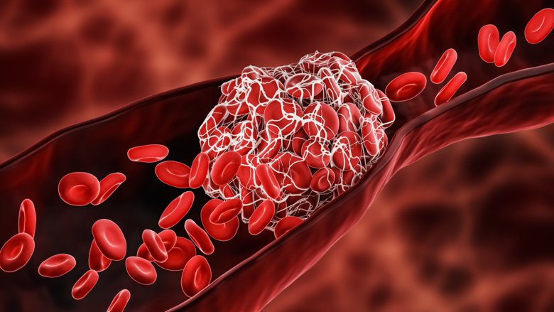 Illustration of blood clot in a blood vessel.