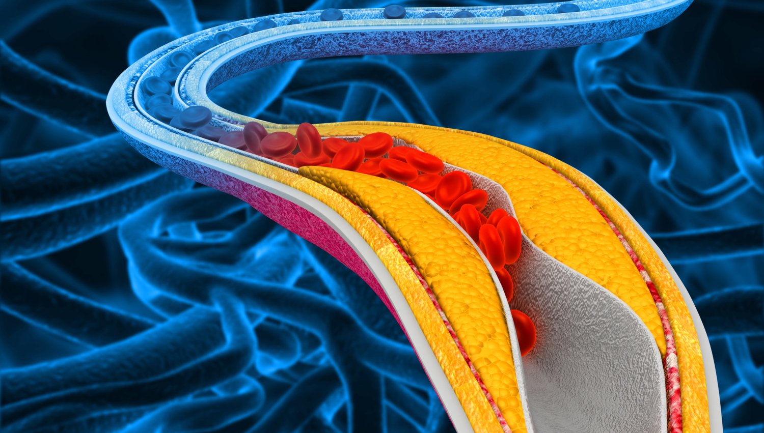 Illustration of the accumulation of cholesterol in the blood vessels