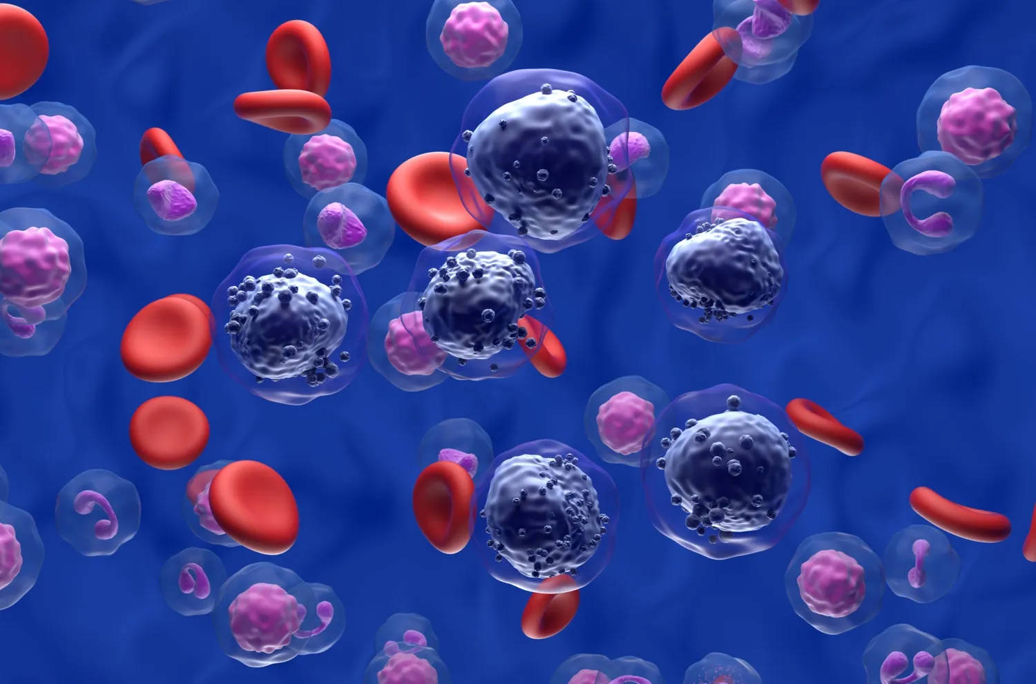 Illustration av celler från akut myeloisk leukemi (AML) i blodflödet