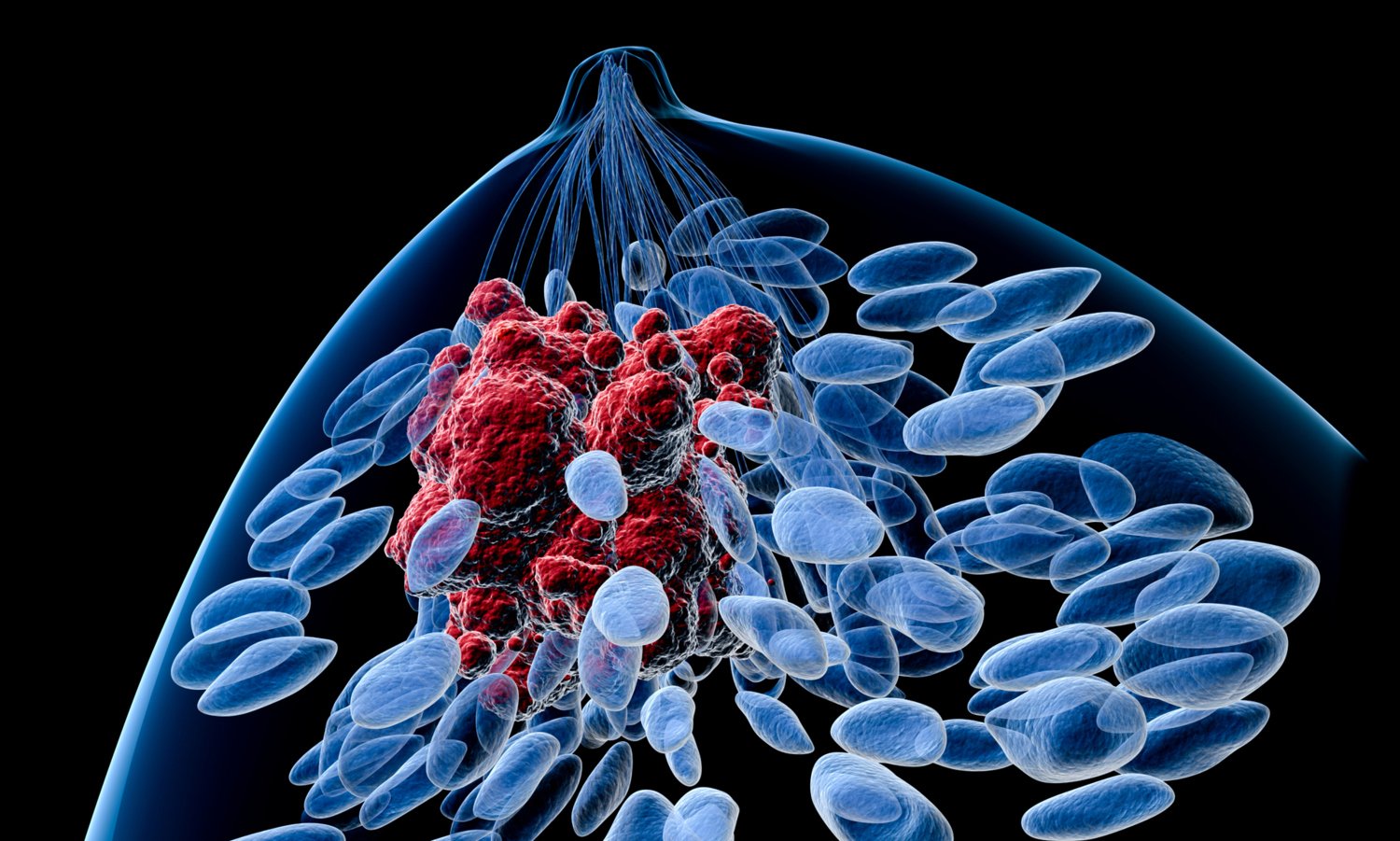 Illustration of breast cancer tumour.