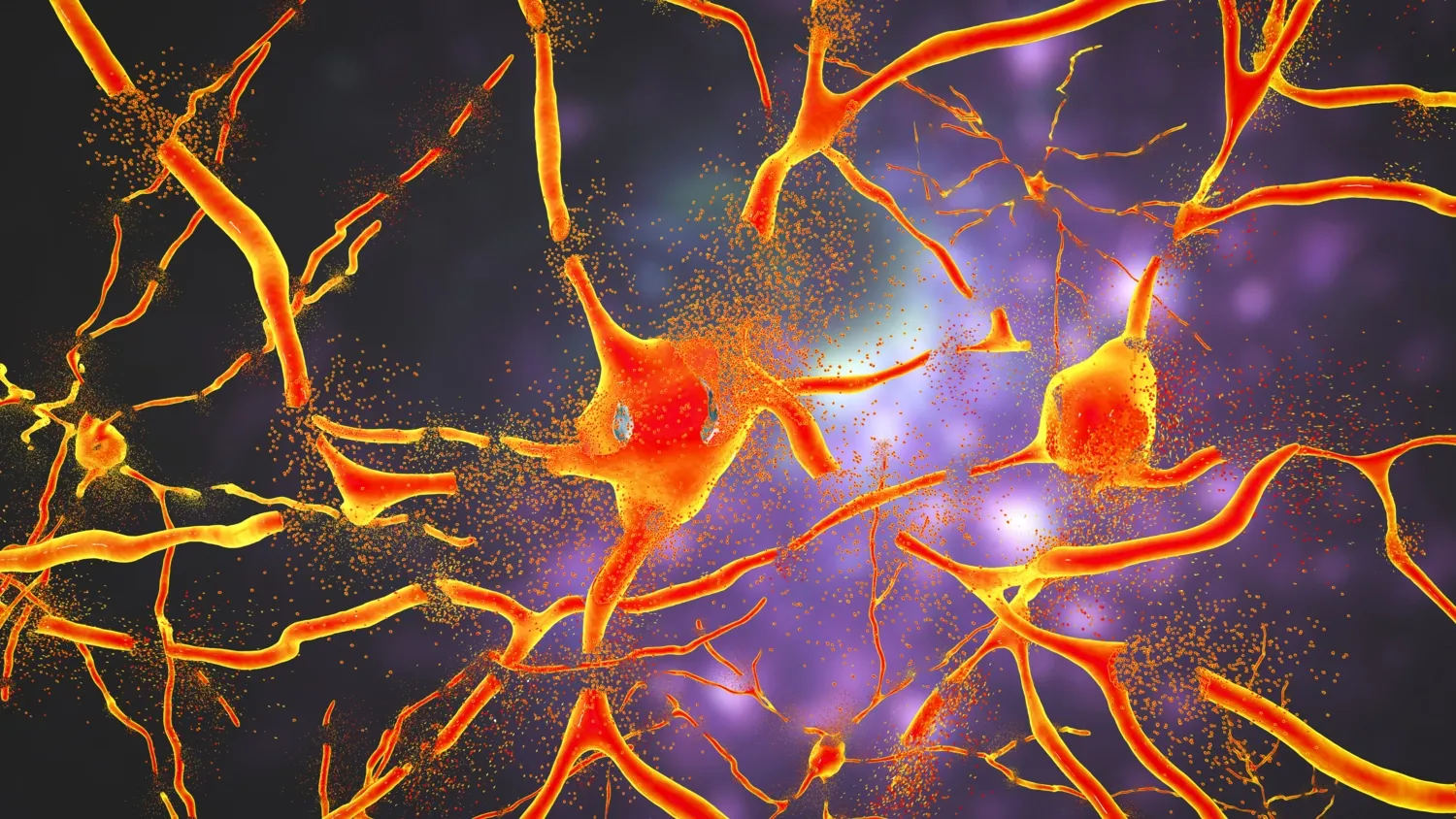 Destruction of neurons of Dorsal striatum, conceptual computer illustration. Dorsal striatum is a nucleus in the brain basal ganglia.