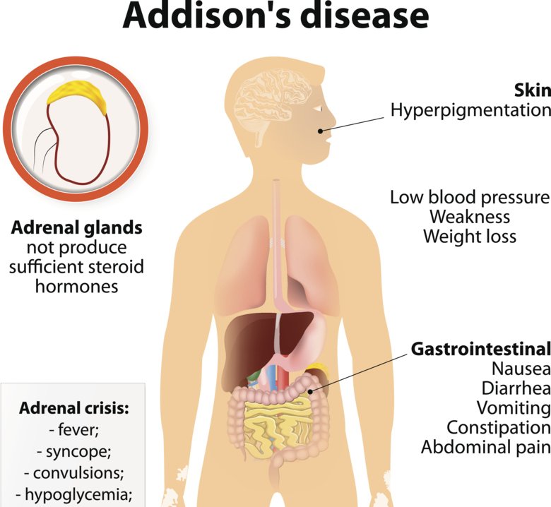 Illustration of symptoms associated with Addison's disease. Symptoms include fatigue, nausea, weight loss and weakness.