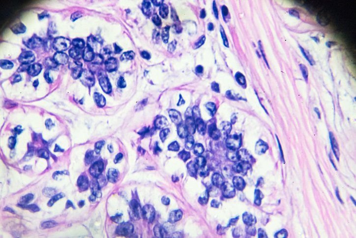 Tissue sample of a breast tumour