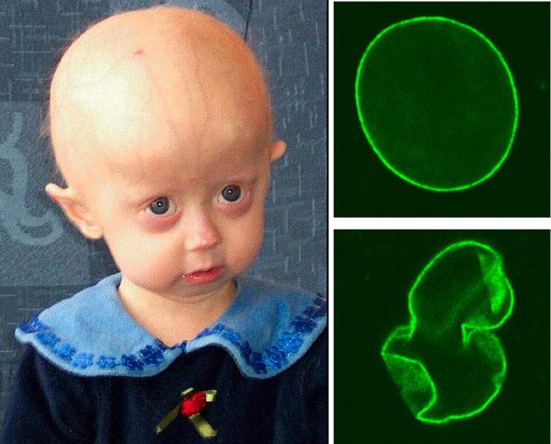 Child with progeria and images comparing the cell nucleus from a healthy individual and a patient with progeria