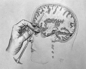 Black and white historical illustration of a surgical procedure on the brain