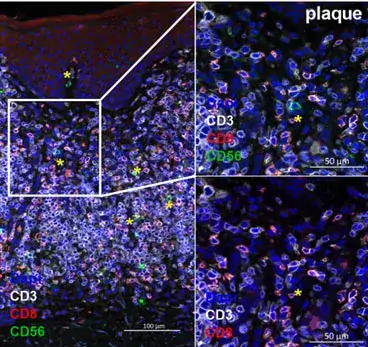 NK Cells in skin.