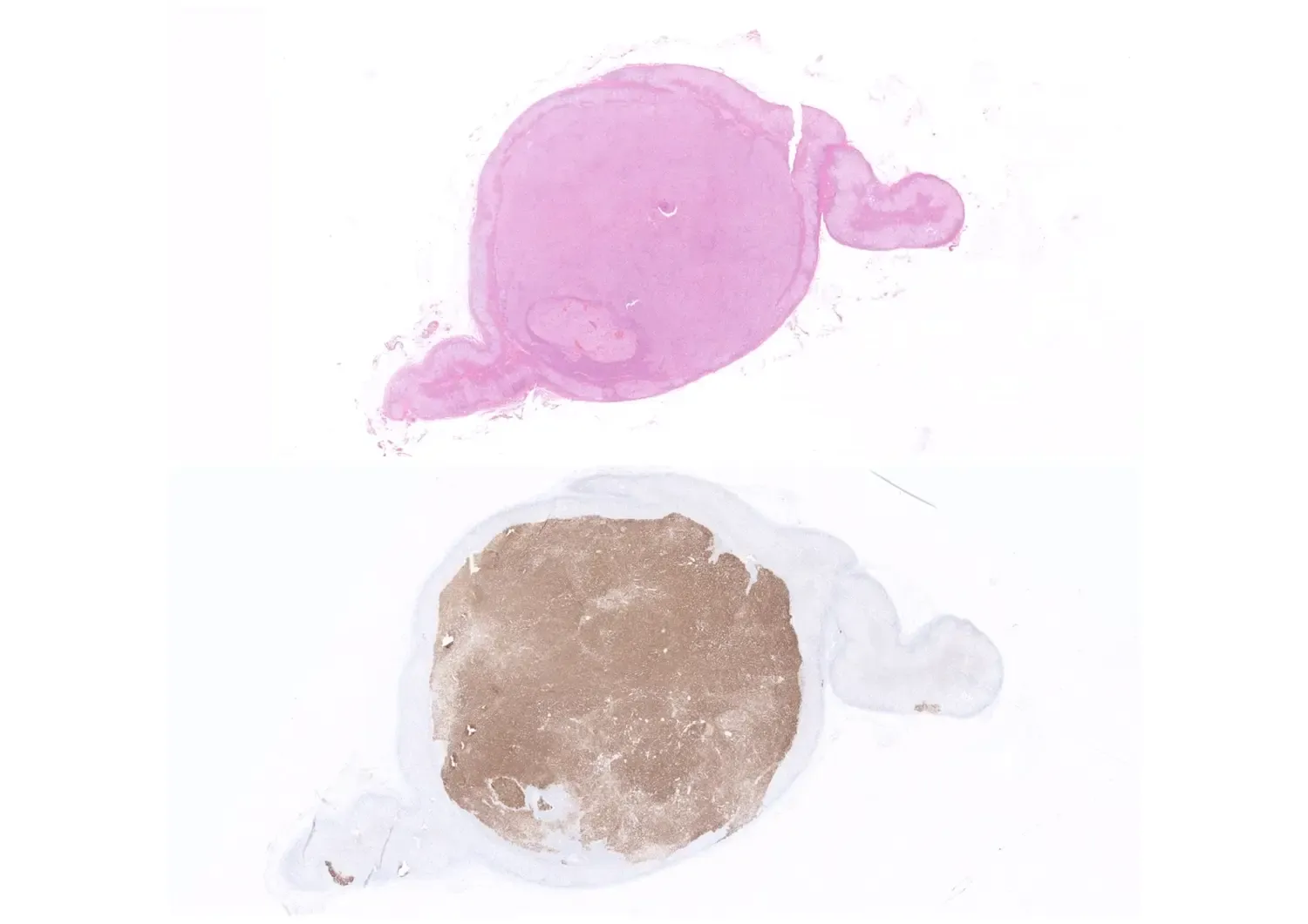 Histological image of an adrenal gland tumor, stained using two different methods.