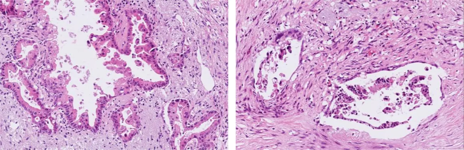 Image of Thin sections of tumour tissue from patients with pancreatic cancer. On the left is untreated tissue and on the right is tissue treated with sodium selenite. Under the microscope, the treated tissue showed clear signs of tumour shrinkage.