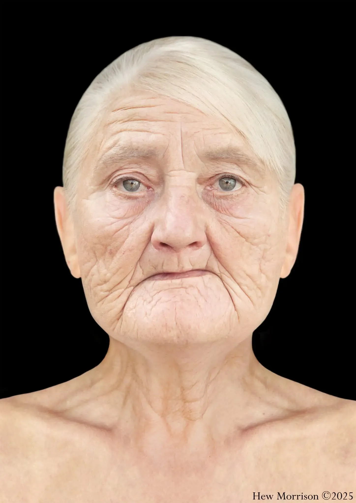 An elderly woman from P&auml;lk&auml;ne following facial reconstruction.