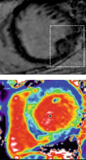 Localized and diffuse scaring of the myocardium