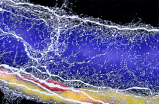 Genetic risk factors for severe COVID-19 identified