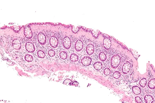 Image to illustrate an article on microscopic colitis.