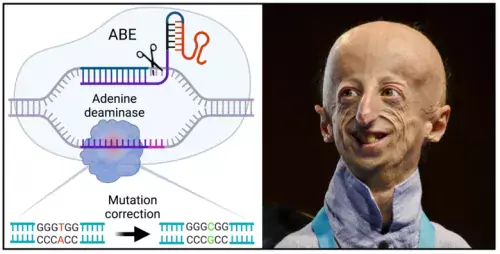 Collage, with a schematic illustration to the left and a portrait photo of a young man with progeria to the right
