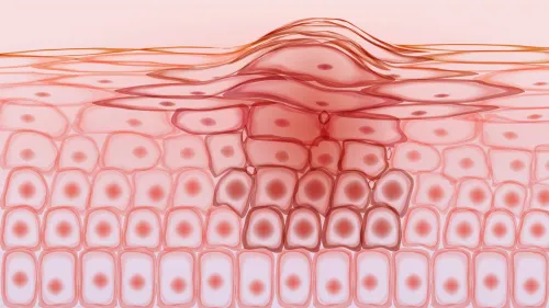 Illustration of skin cancer cells.