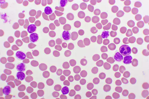 Acute lymphocytic leukemia in blood smear
