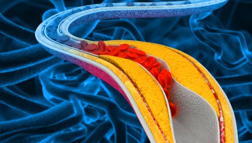 Illustration of the accumulation of cholesterol in the blood vessels