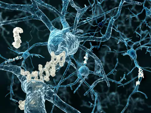 Amyloid plaques in the brain in Alzheimer&#039;s disease