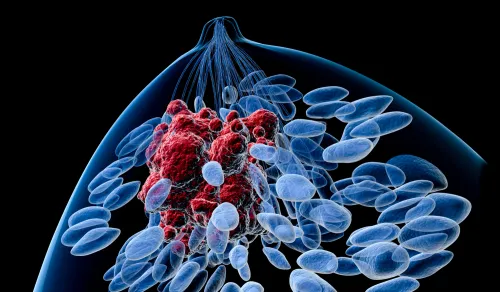 Illustration of breast cancer tumour.