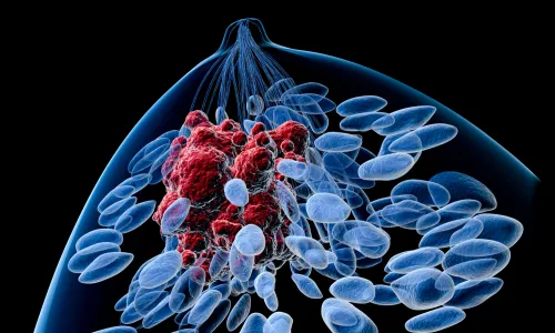 Illustration of breast cancer tumour.