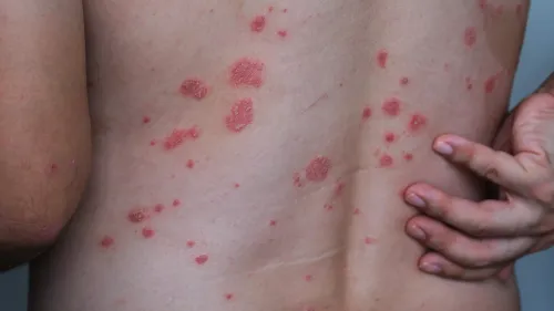 A man with psoriasis on his back