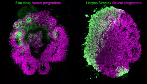 Human brain organoids stained for neural stem cells (magenta) and Zika virus (left, green) and Herpes Simplex Virus 1 (right, green).