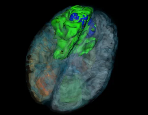 A computer generated 3D-visualization of a brain from a patient with glioma where the tumor is red, the necrotic core is blue and the edema is green.